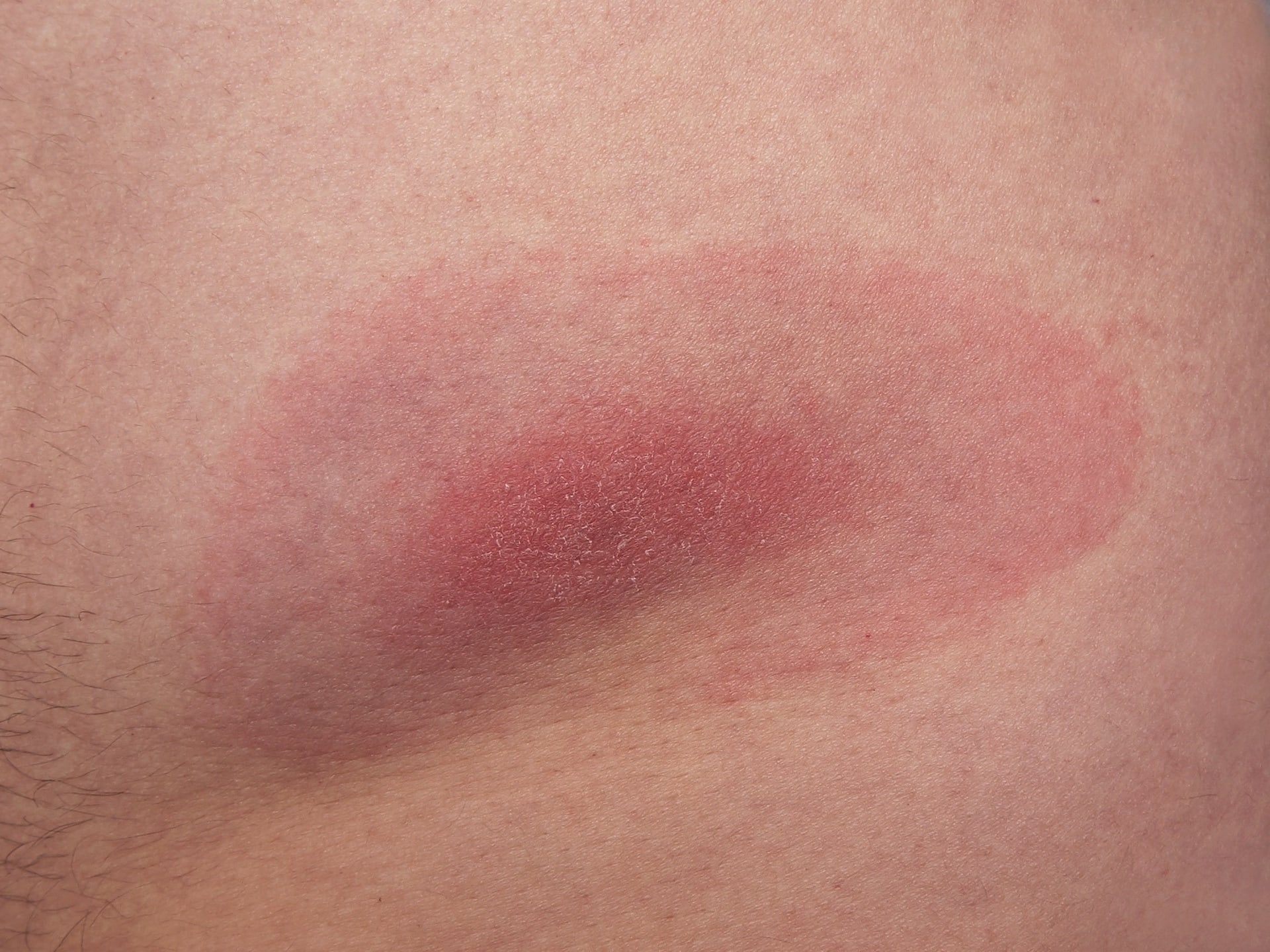 Red bullseye rash on skin after tick bite