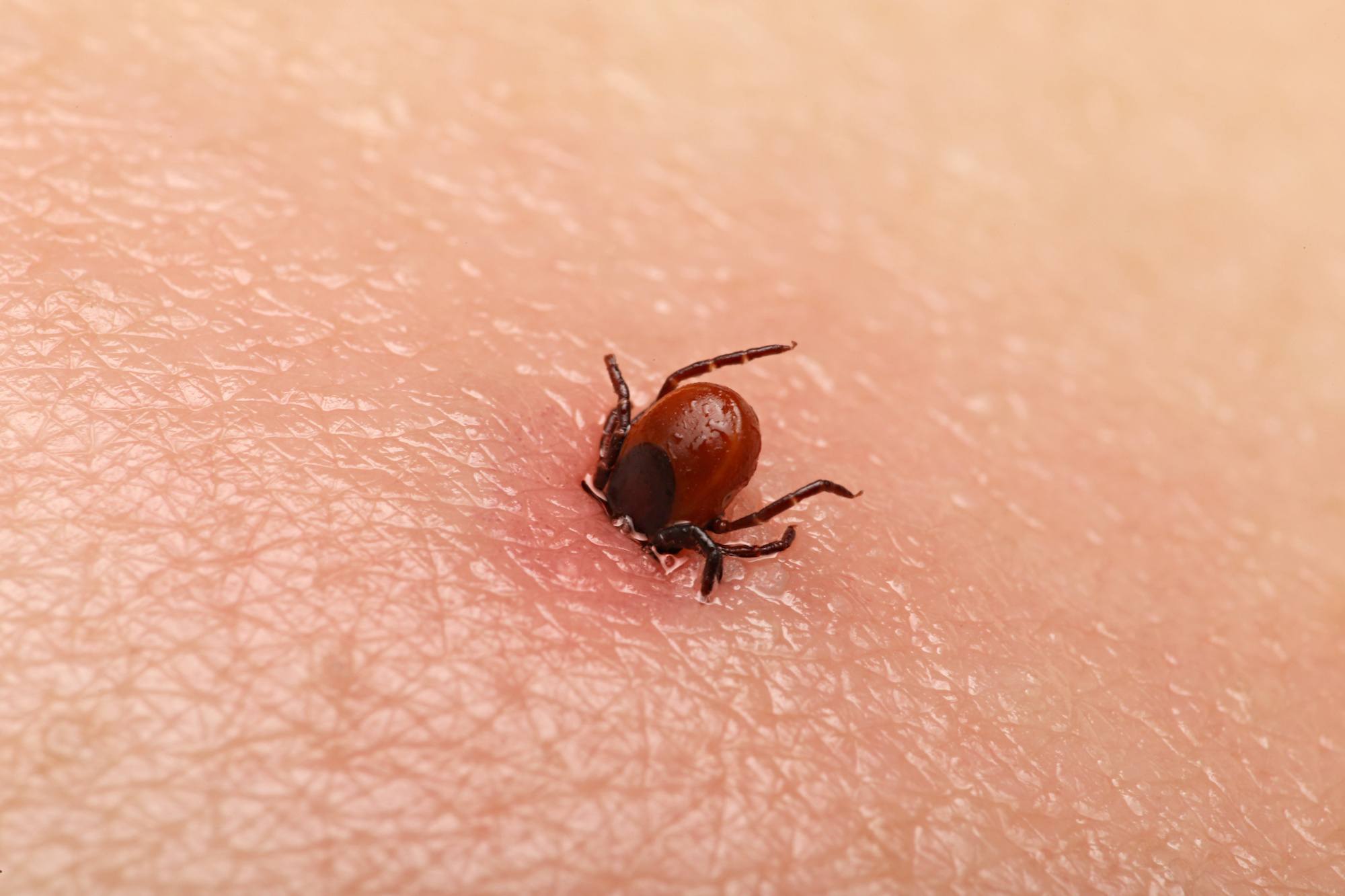 Tick embedded into skin